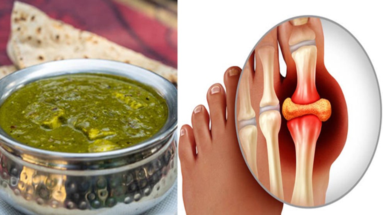 High Uric Acid Me Palak Khana Chahiye Ya Nahi Can We Eat Spinach in