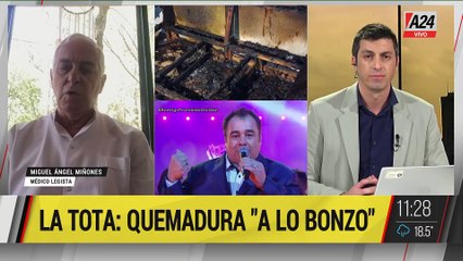  TOTA SANTILLÁN: "TODO APUNTA A UNA QUEMADURA A LO BONZO" - Médico Legista