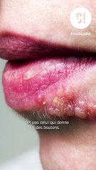 L’herpès peut-il être fatal ? On vous parle du cytomégalovirus, un virus de la famille de l’herpès.