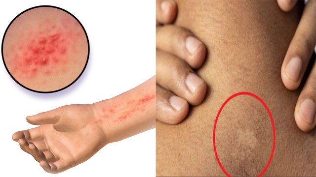 Blood Allergy Symptoms & Home Remedy: Khoon Me Allergy Ke Lakshan & Ilaj | Boldsky