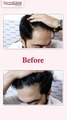 Long Hair FUE Transplant, Instant Results & No Downtime | DermaClinix Experts