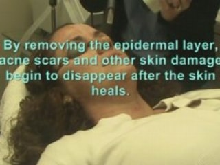 Acne Scar Removal at South Coast MedSpa