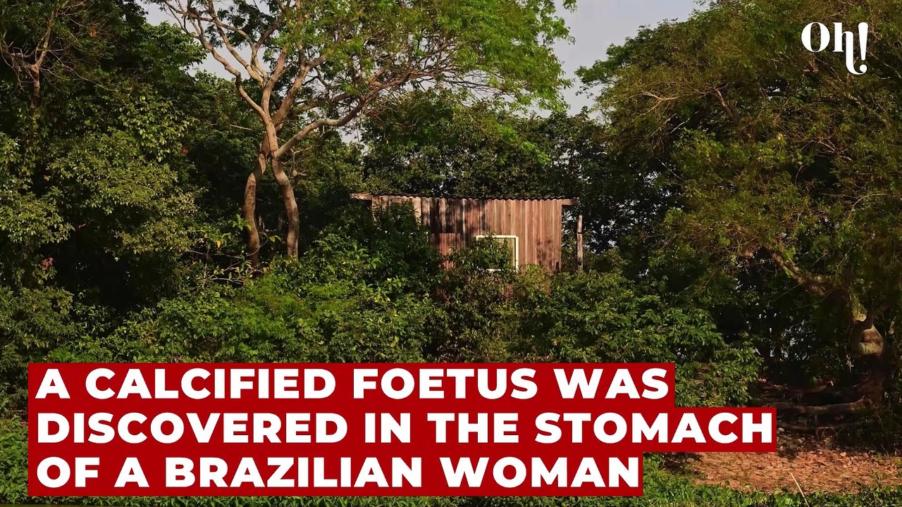 81-year-old Brazilian woman dies after doctors remove a 56-year-old 'stone baby' from her body
