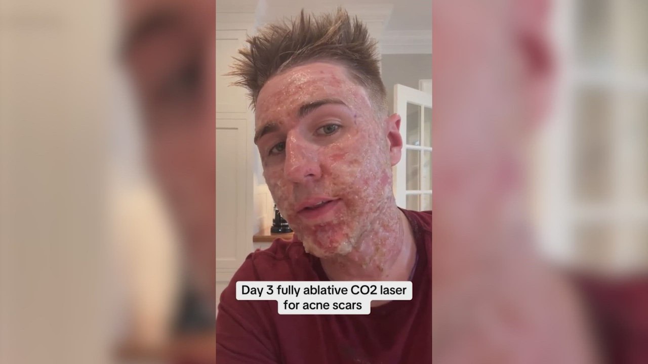 Adiós a las cicatrices del acné: un dermatólogo revela el tratamiento revolucionario