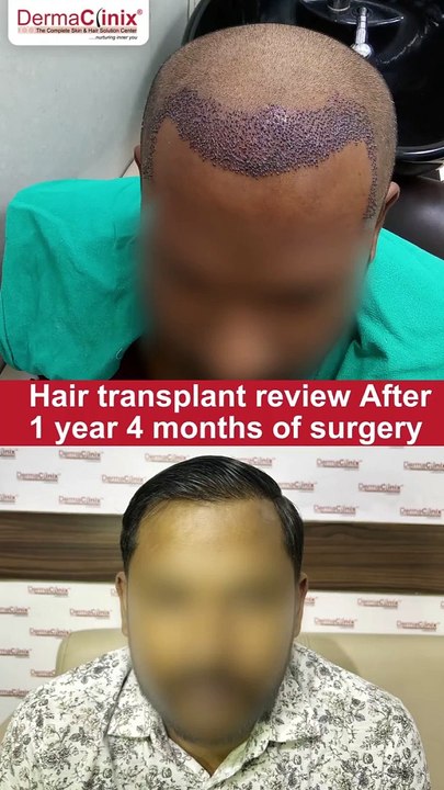 See the Hair Transformation at DermaClinix by Dr. Amrendra Kumar – Book Your Consultation Now!
