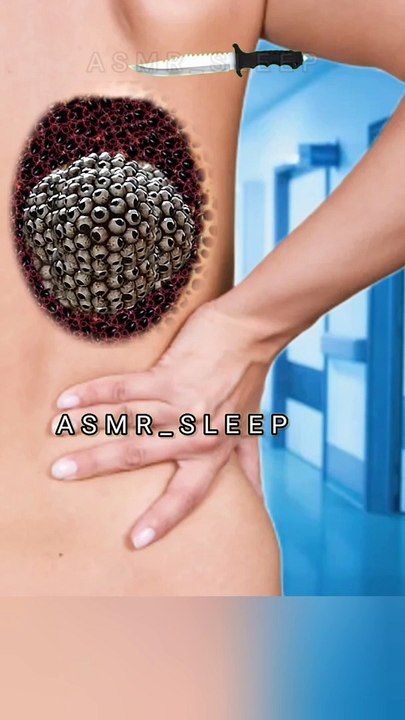 American Women back maggots removal 2d animation || #asmrcleaning #asmr