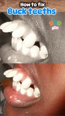 How to fix buck teeths