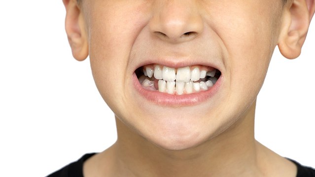 bd-causas-y-tratamientos-del-bruxismo-infantil-300924