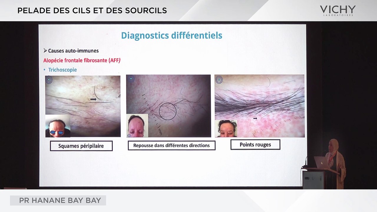Pelade des cils et sourcils par Pr H. BAY BAY