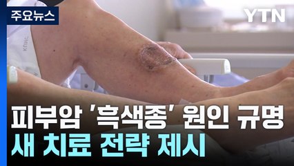 항암제 잘 안 듣는 '흑색종' 원인 규명...새 치료법 제시 / YTN