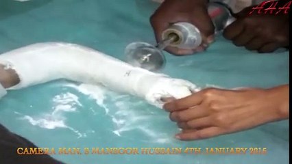 Hammad's Plaster is being remover from his arm on 4th January 2015