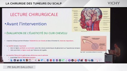 La chirurgie des tumeurs du SCALP par Pr S. GALLOUJ