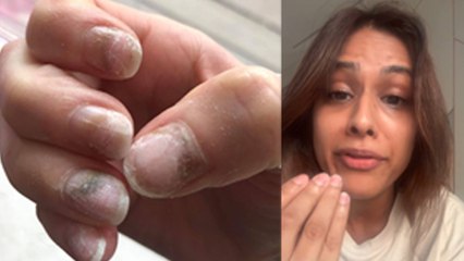 Nia Sharma Severe Pain After Removing Nail Extension,Side Effects In Hindi..| Boldsky