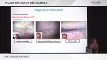 Pelade des cils et des sourcils par Pr H. BAY BAY