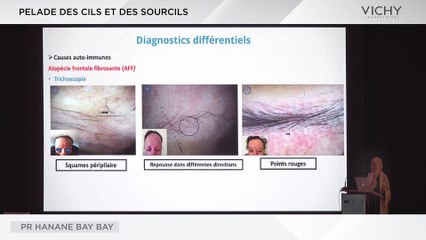 Pelade des cils et des sourcils par Pr H. BAY BAY