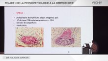 Pelade : De La physiopathologie à la démoscopie par Dr N. AMMAR