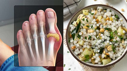 Is Sabudana Good For Uric Acid: High Uric Acid Me Sabudana Khana Chahiye Ya Nahi | Boldsky