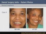 Less cost dental implants in India and extensive dental care