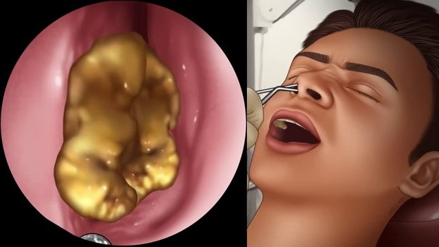 ASMR _ Nose Cleaning, Rhinitis, Endoscopy _ Animation
