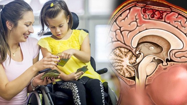 Hunter Syndrome Causes, Symptoms, Treatment, Recovery Time...| Boldsky