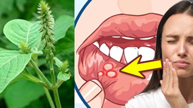 Chirchita Ke Patte Ke Fayde:चिरचिटा के पत्ते किस काम आते है, Mouth Ulcer To Diabetes Control|Boldsky