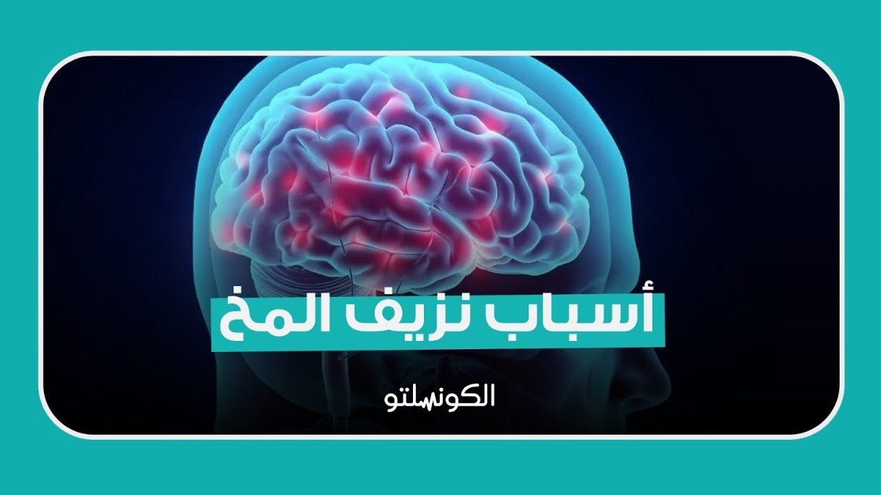 بعد وفاة عاطف بشاي .. ما أسباب نزيف المخ؟