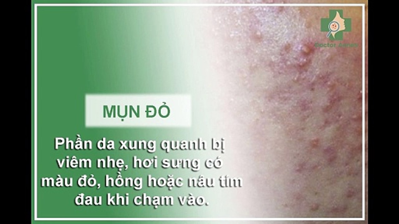 Phân biệt các loại mụn và cách điều trị cho từng loại mụn