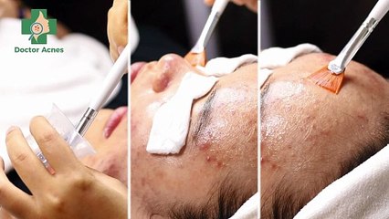 Peel da trị mụn là gì? Ưu và nhược điểm trong điều trị mụn