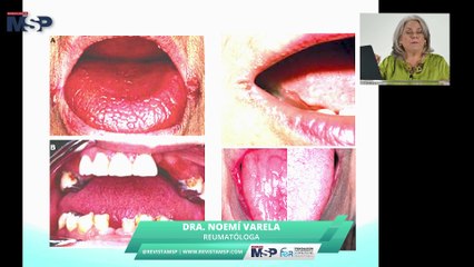 Los grandes desconocidos de la reumatología: Síndrome de Sjögren