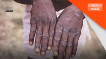 Mpox: 15 negara Afrika berdepan penularan aktif