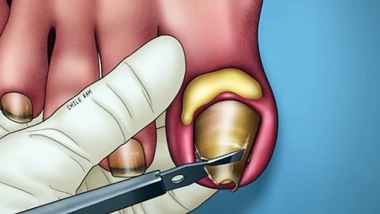 ASMR Satisfying videos ASMR video that focuses on treating old ingrown toenails and pus:
