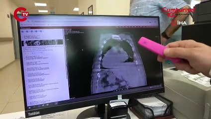 Türkiye'de bir hasta dünya tıp literatürüne girdi: 'Giresun Sendromu'