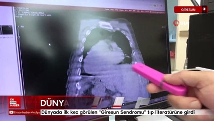 Dünyada ilk olan bir vaka Giresun Sendromu adıyla tıp literatürüne girdi