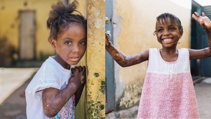 Toddler unable to bend arms due to burns hugs parents after life-changing surgery