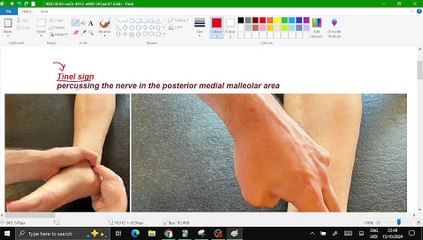 2. tarsal tunnel syndrome