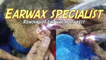 Womans Massive Dark Earwax Extraction