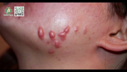 Thuốc tiêm sẹo lồi có hiệu quả không? Giá bao nhiêu?