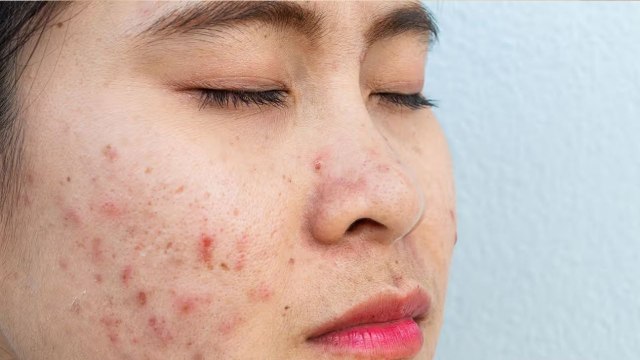 Honey On Face Overnight Benefits: Honey Chehre Par Lagane Se Kya Hota Hai,Dry Skin Cure से लेकर Acne