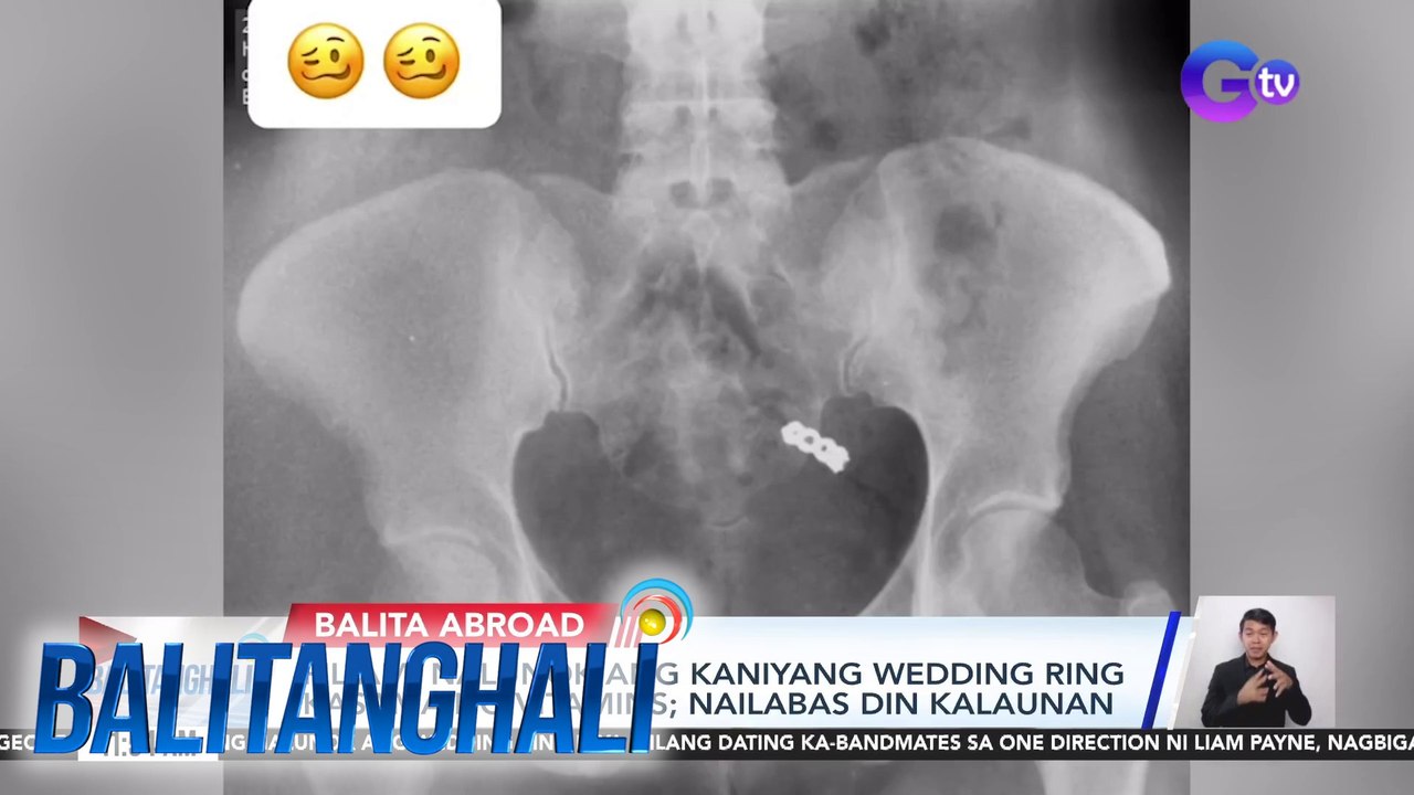 Fil-Am, nalunok ang kaniyang wedding ring kasa ma ng vitamins; nailabas din kalaunan | Balitanghali
