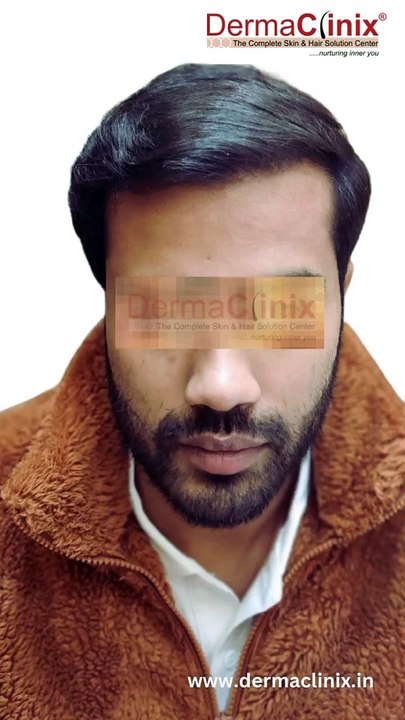 Best Hair Transplant Results ! DermaClinix ! Dr Amrendra Kumar
