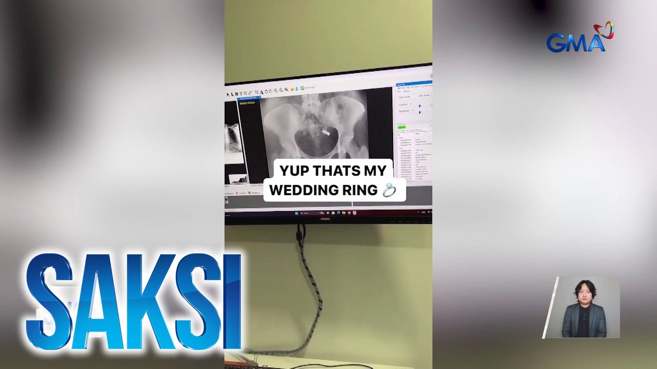 Babae, aksidenteng nalunok ang wedding ring kasama ng mga ininom na vitamins | Saksi