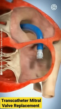 Altavalve- Transcatheter Mitral Valve Replacement (TMVR) #shorts #medical #animation