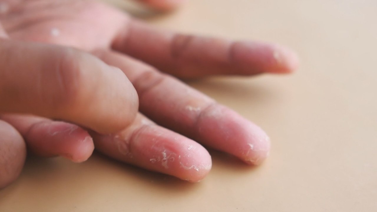 Fundación Psoriasis celebra 20 años impulsando calidad de vida y avances en tratamientos