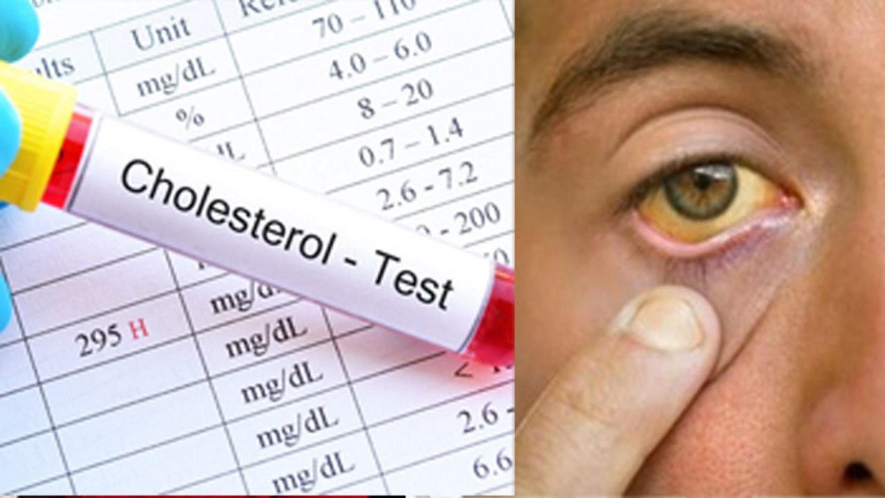 High Cholesterol Symptoms In Eyes: आंखों में  कोलेस्ट्रॉल के लक्षण क्या होते है ? | Boldsky