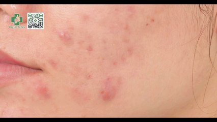 Mụn chai là gì? Cách điều trị mụn chai hiệu quả hiện nay