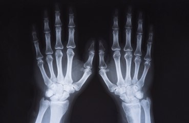 Artificial intelligence (AI) can help doctors spot broken bones on X-rays
