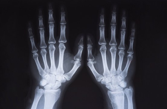 Artificial intelligence (AI) can help doctors spot broken bones on X-rays