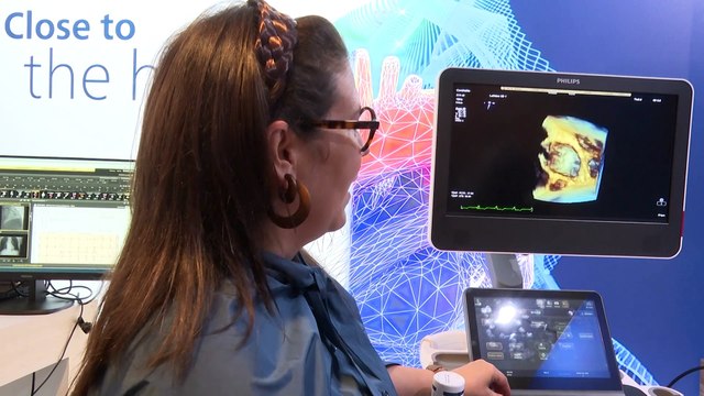 Innovaciones de ecocardiografía basadas en IA se presentan en el SEC