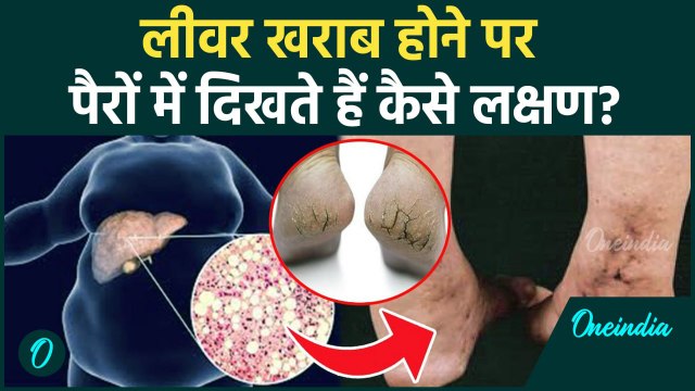 Liver Damage Symptoms: पैरों में दिखने वाले ये लक्षण, लीवर डैमेज होने का बड़ा संकेत, कैसे बचें?
