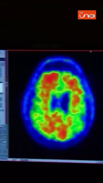 #EnRedUno | ¿Tomar café puede prevenir el alzhéimer? ¿Qué dicen los expertos?